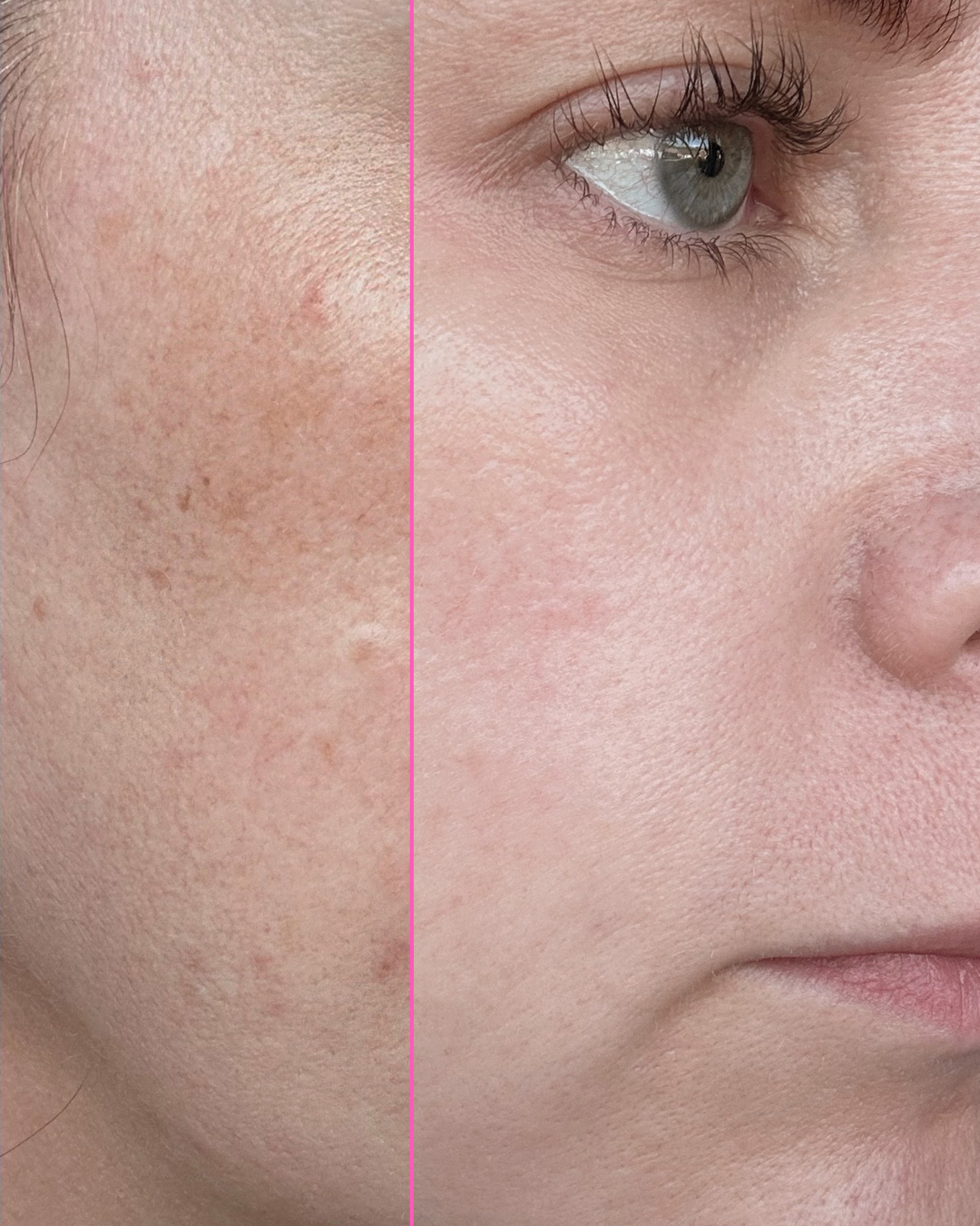 Close-up of a person's face split vertically down the middle, showing a before-and-after style comparison of skin texture and hyperpigmentation on the left side.